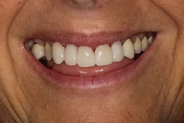 Un primer plano de la sonrisa de una mujer con dientes blancos.