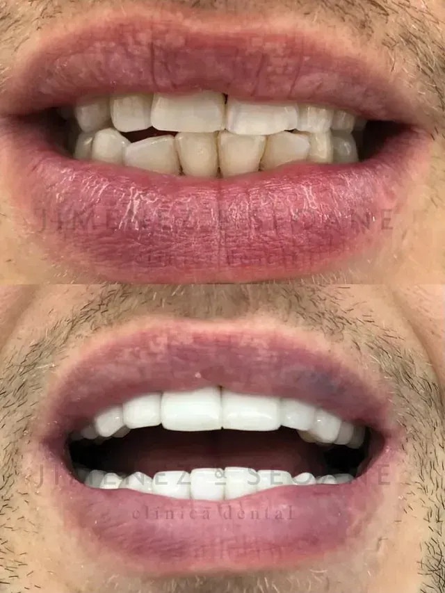 Una fotografía de antes y después de los dientes de un hombre.
