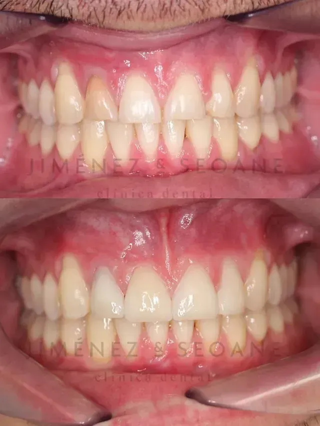 Una fotografía de antes y después de los dientes de una persona.
