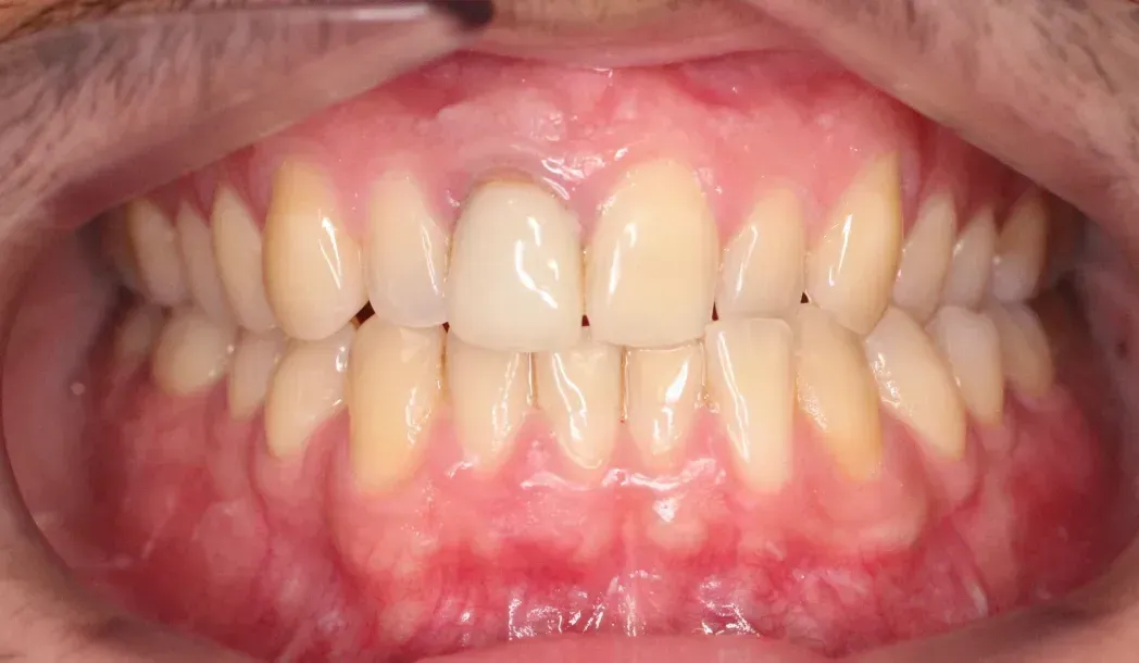 Un primer plano de los dientes de una persona a la que le falta un diente.