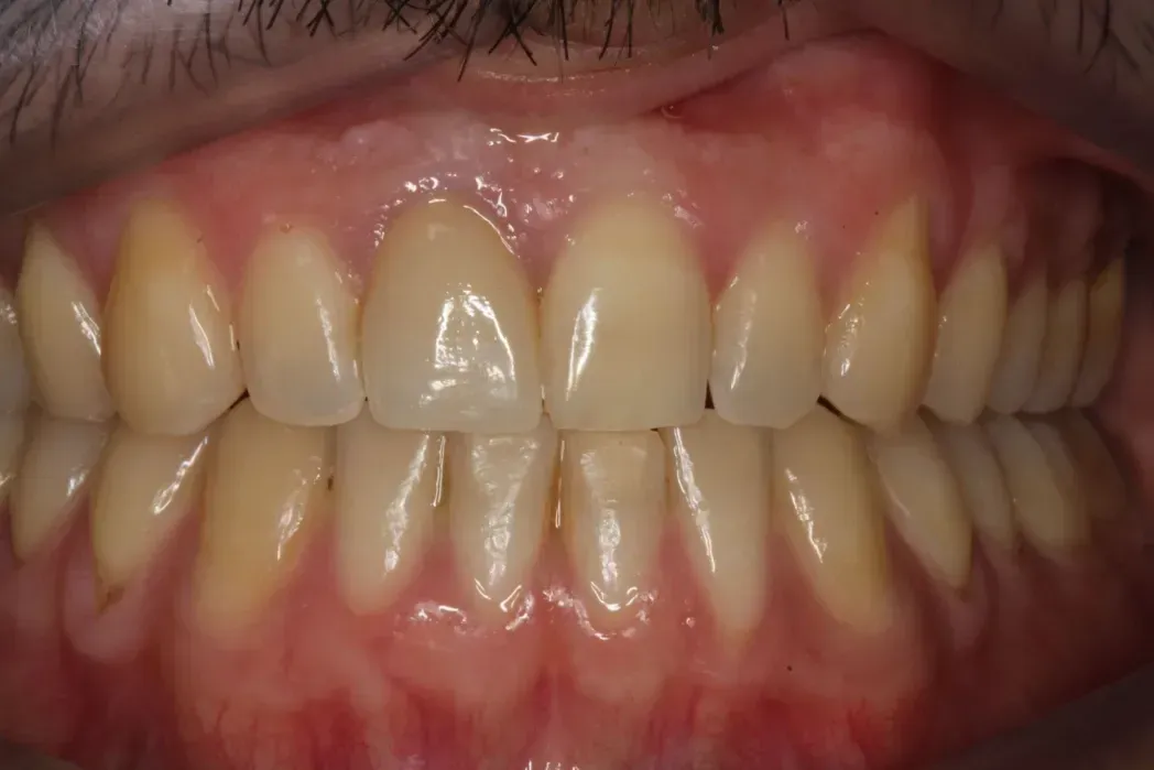 Un primer plano de los dientes y las encías de una persona.