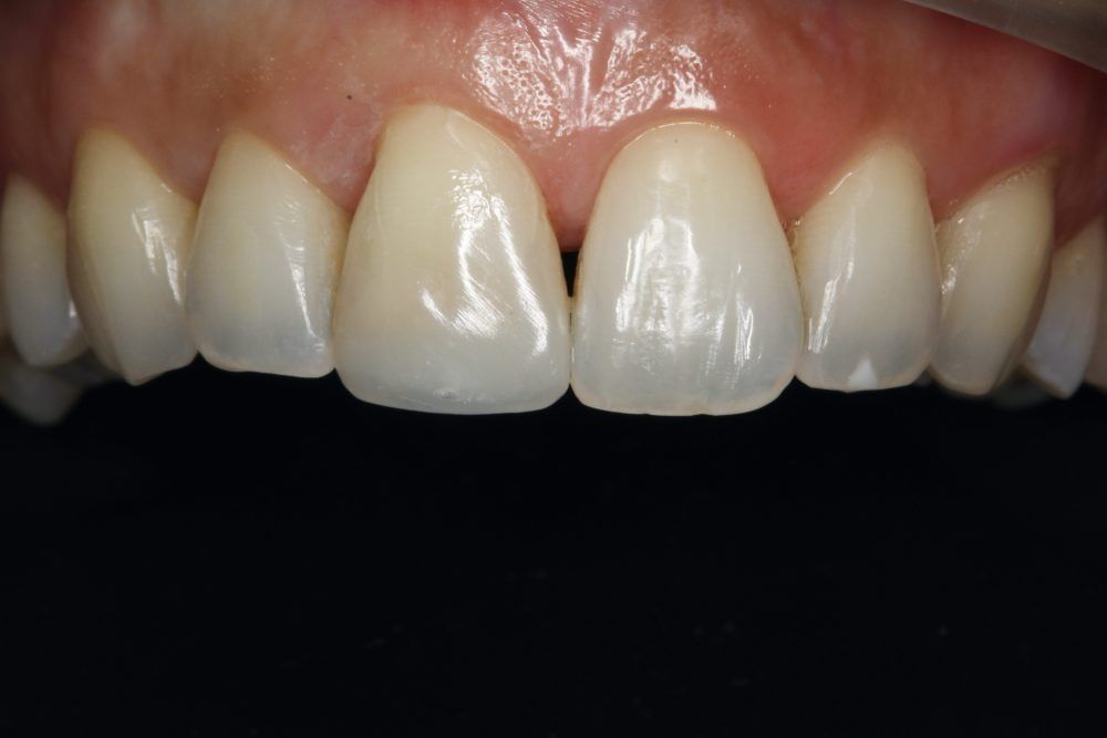 Un primer plano de los dientes de una persona sobre un fondo negro.