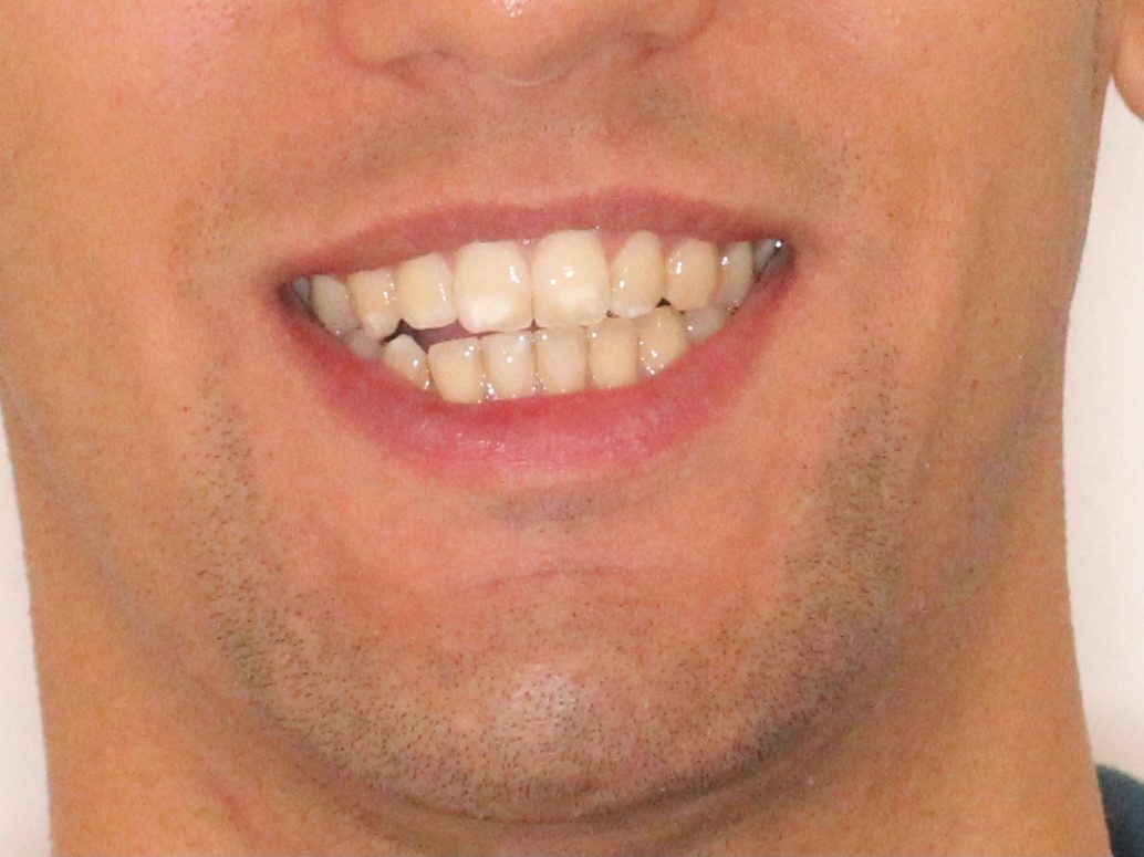 Un primer plano de la boca de un hombre con los dientes visibles.