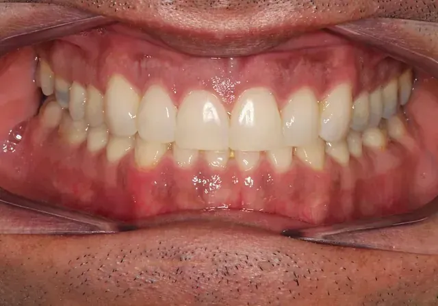 Un primer plano de la boca de un hombre con dientes blancos.
