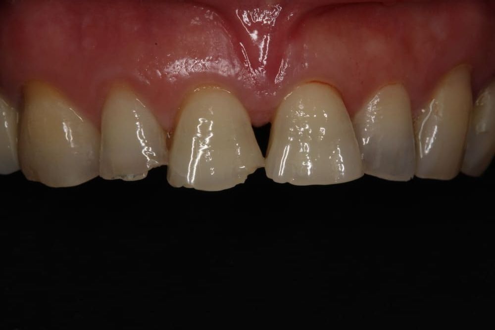 Un primer plano de los dientes de una persona con un fondo negro.