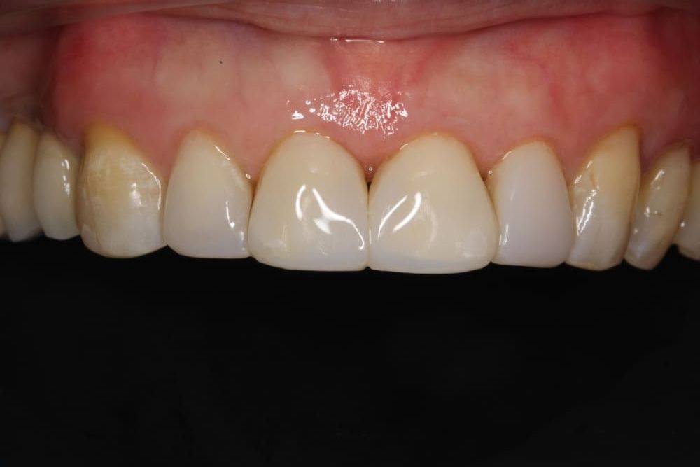 Un primer plano de los dientes de una persona sobre un fondo negro.
