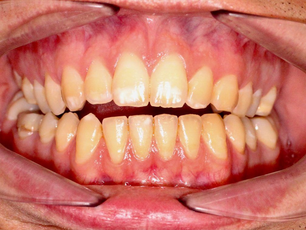 Un primer plano de los dientes de una persona con la boca abierta.
