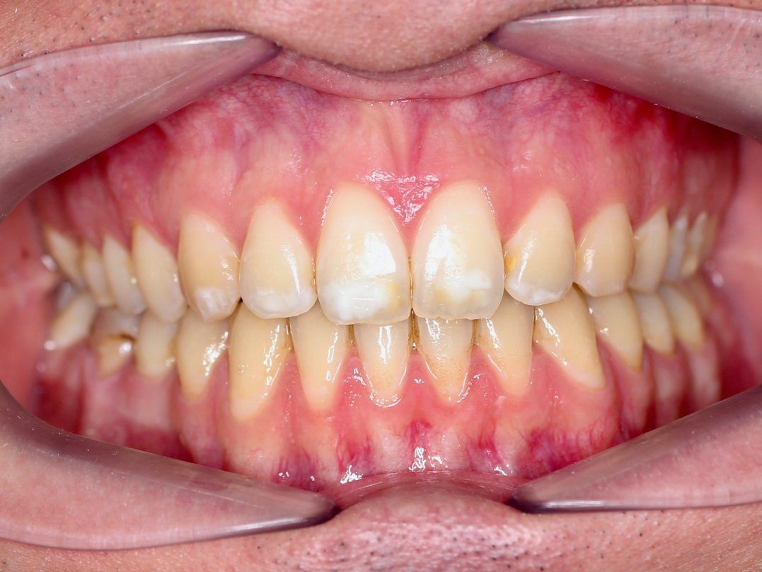 Un primer plano de los dientes de una persona con un protector bucal.