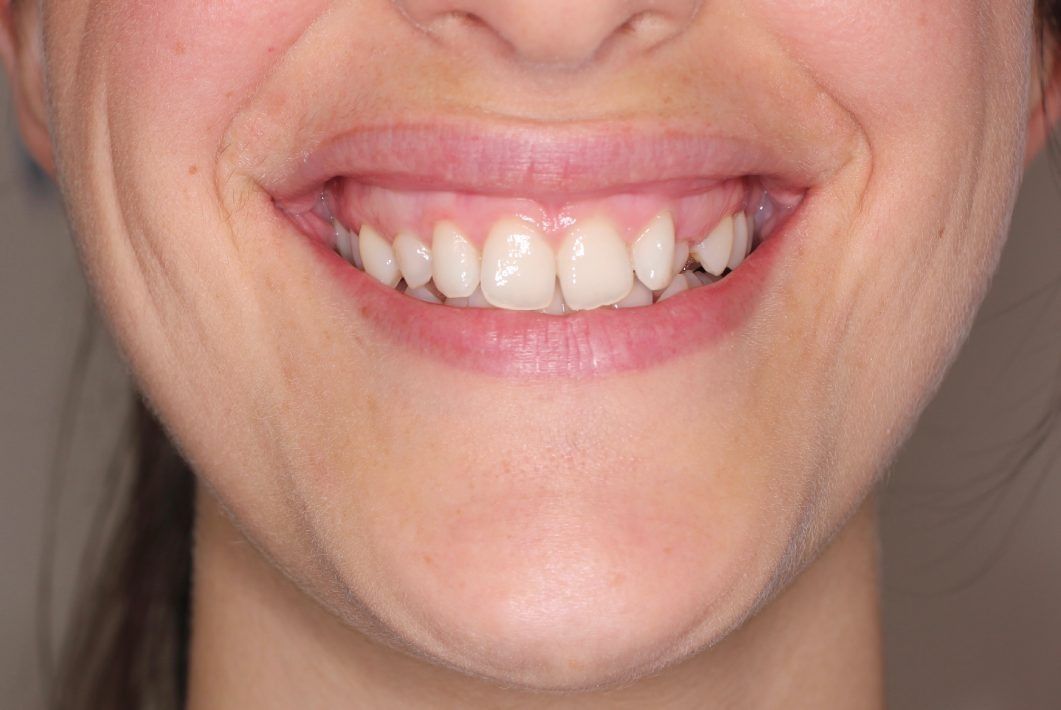Un primer plano de la sonrisa de una mujer con dientes blancos.