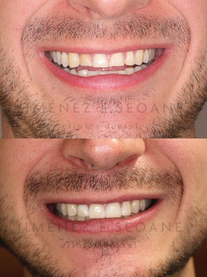 Una foto de antes y después de los dientes de un hombre.
