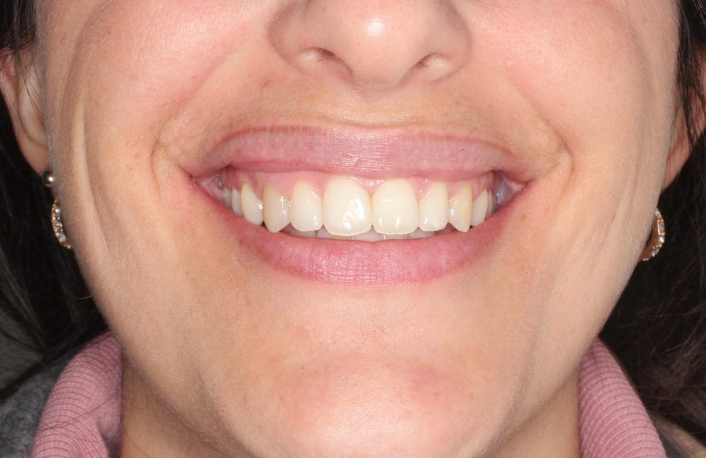 Un primer plano de la sonrisa de una mujer con dientes blancos.