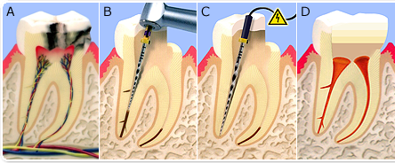 Endodontiebehandlung Verlauf