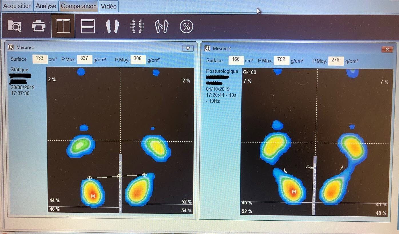 Deux panneaux d'imagerie médicale côte à côte montrant des empreintes de pieds