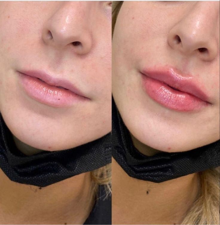 Una foto de antes y después de los labios de una mujer con una máscara negra.
