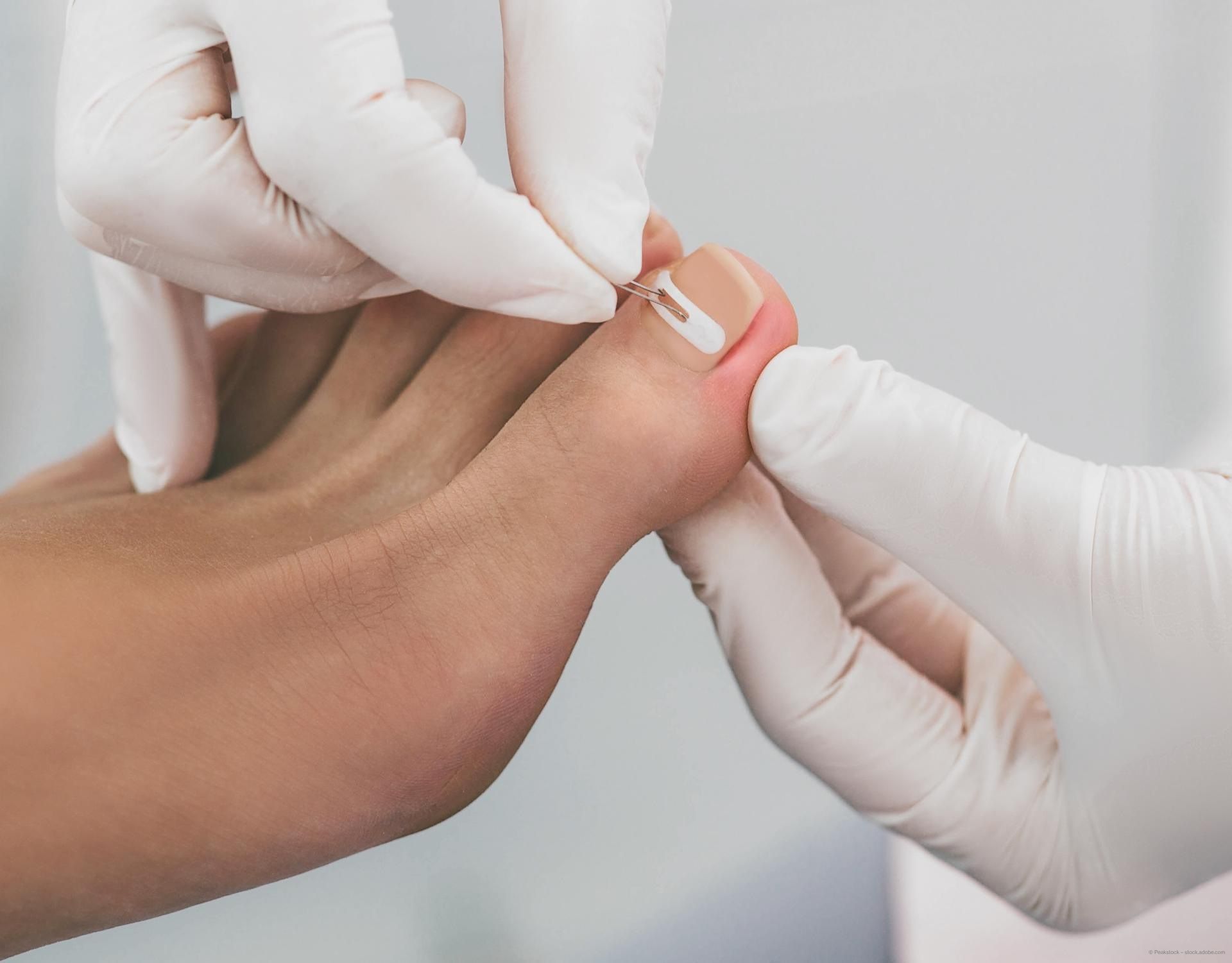 Nagelspangentherapie