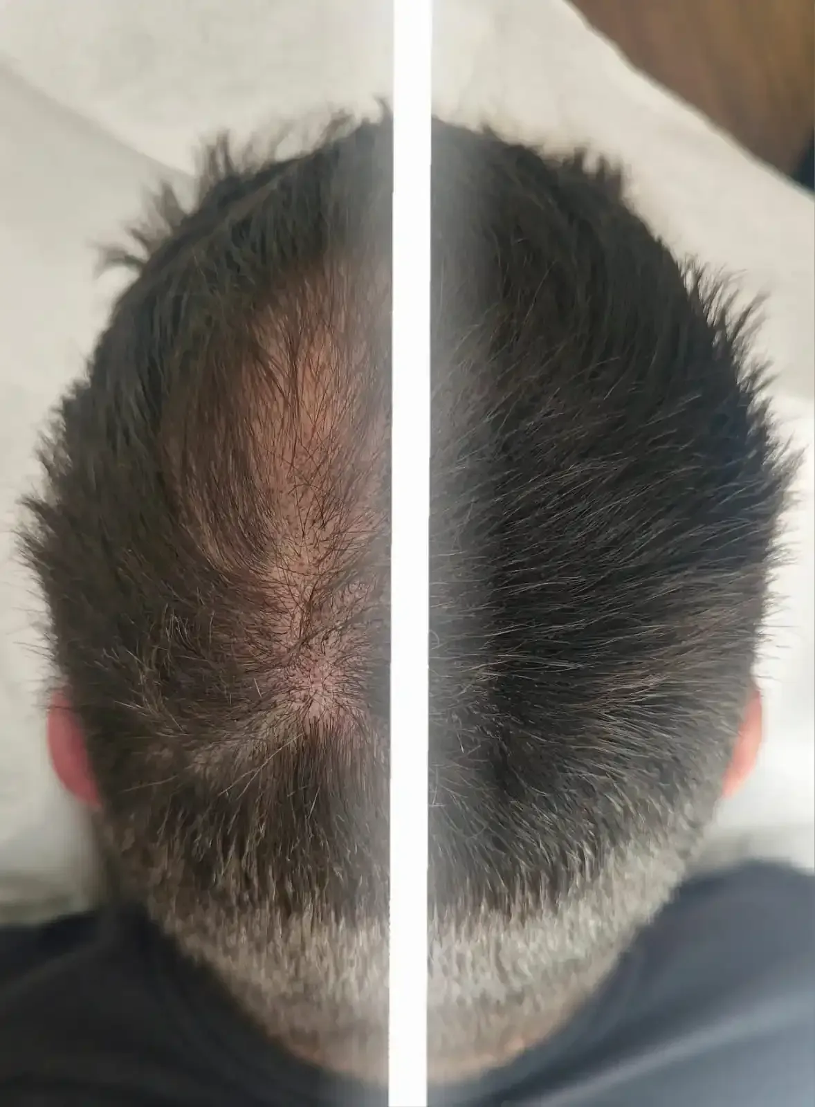 Procedimiento de micropigmentación del cuero cabelludo en curso; pequeños puntos creados en el cuero cabelludo calvo.