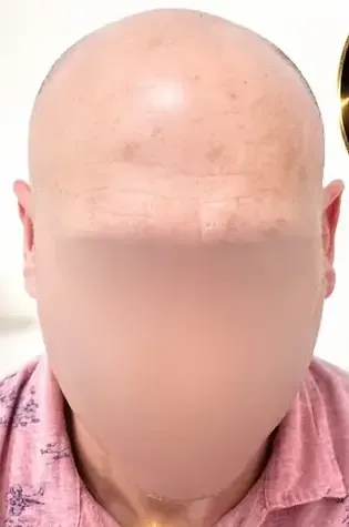 Hombre con cabeza calva, barba corta y gris, vestido con una camisa azul, mirando a la cámara con expresión seria.