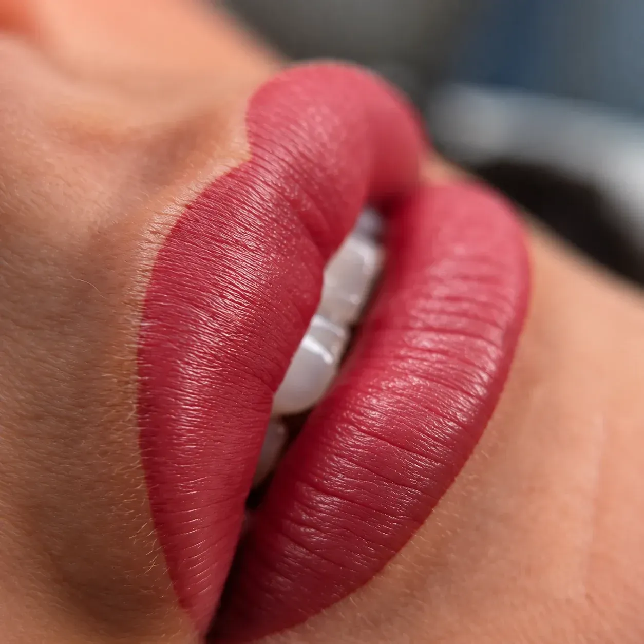 Inyección estética de relleno labial en unos labios carnosos y rosados, con manos enguantadas y una jeringa