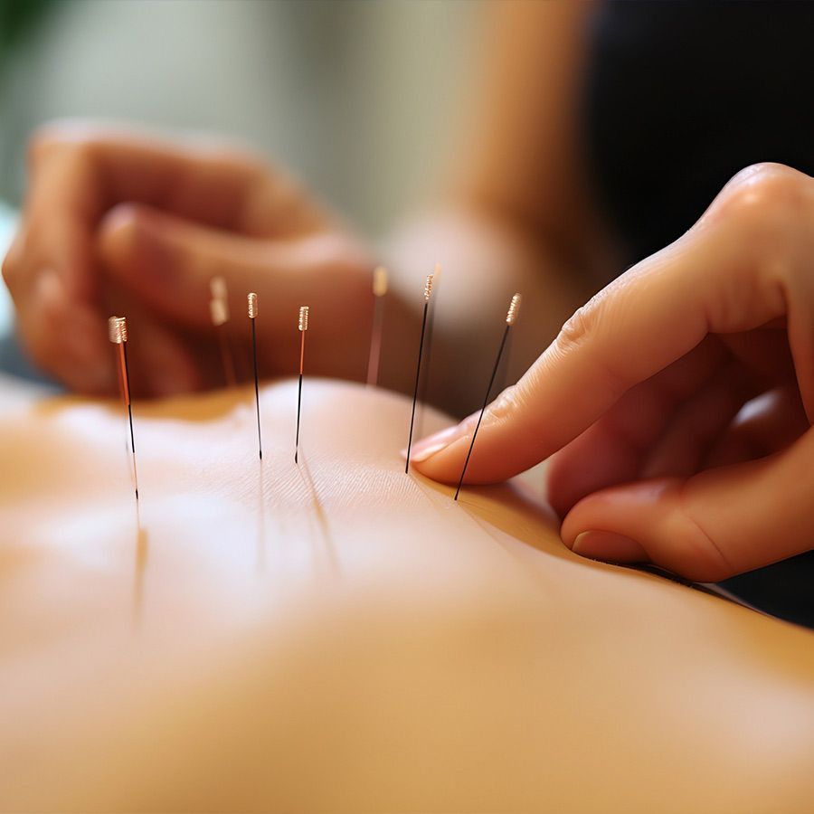 Las manos de un terapeuta colocando agujas de acupuntura en la espalda desnuda de un paciente.