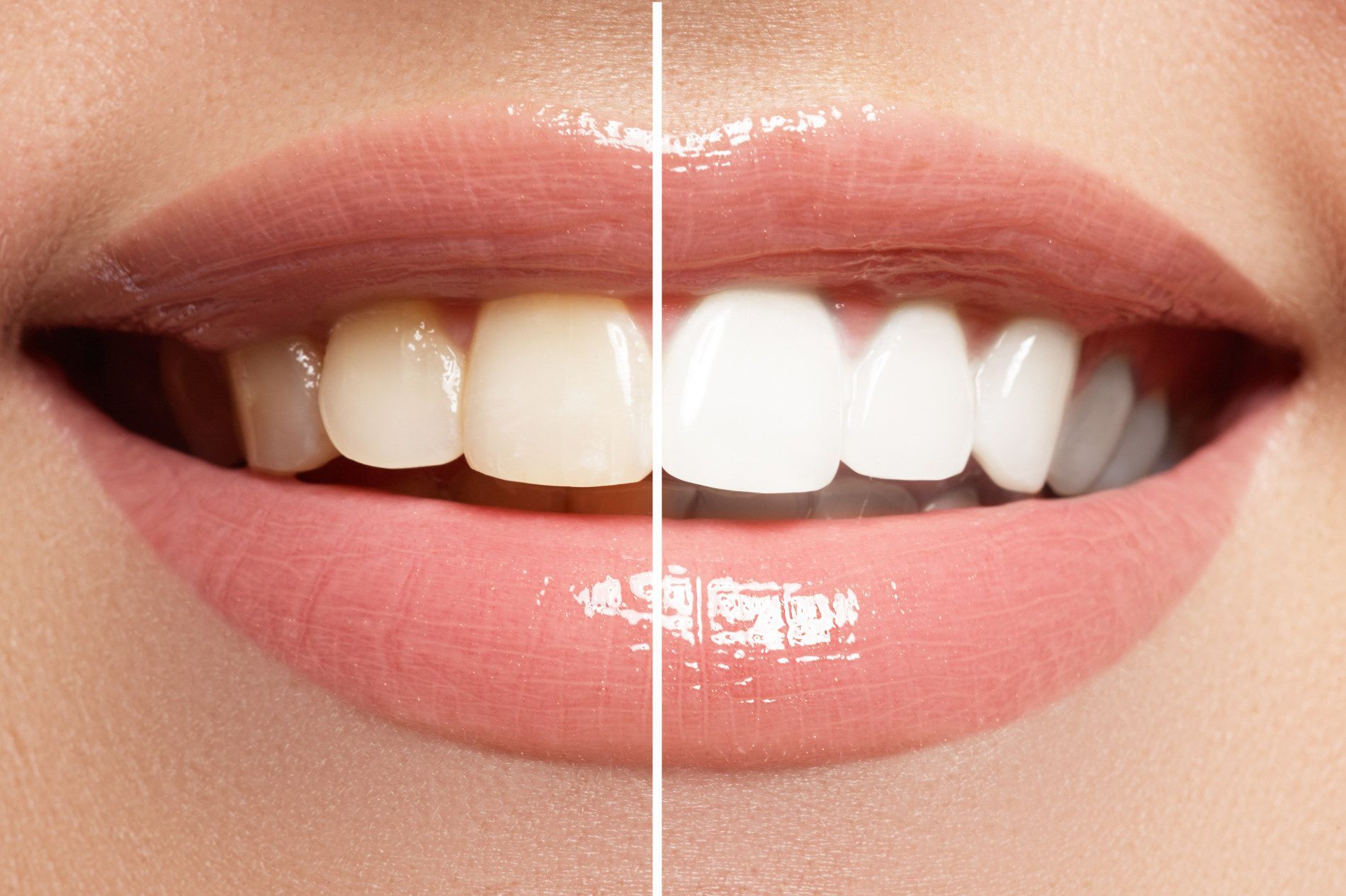 Eine Nahaufnahme von Zähnen einer Frau vor und nach der Zahnbleaching.