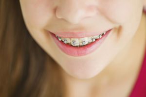 Un primer plano de la boca de una niña con aparatos dentales.