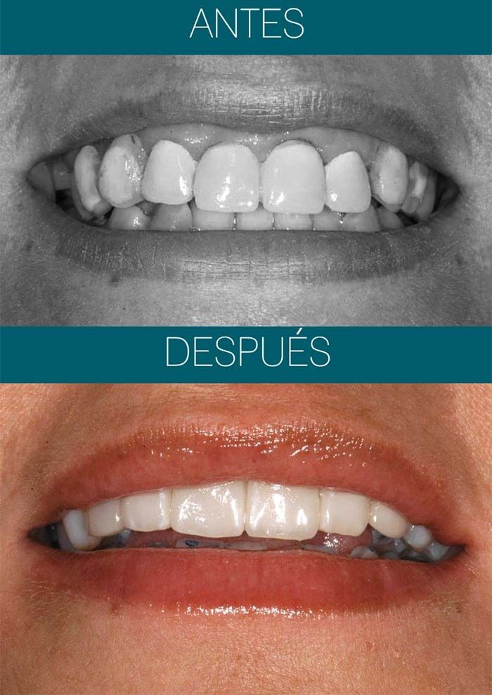 Una foto de antes y después de los dientes de una mujer.
