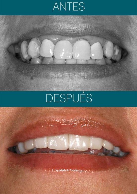 Una foto de antes y después de los dientes de una mujer.