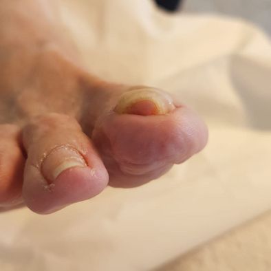 AVANT - ongle avant Orthonyxie pied droit Mme A