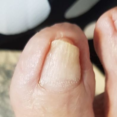 AVANT - ongle avant Orthonyxie pied droit Mme A