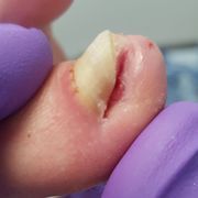 APRÈS 1er Soin - ongle incarné avec infection Mme D