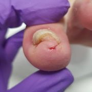 APRÈS 1er Soin - ongle incarné avec infection Mme D