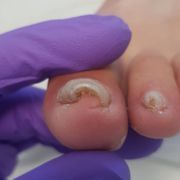 AVANT 2ème soin d'entretien - ongle incarné avec infection Mme D