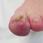 AVANT - ongle incarné Mme D