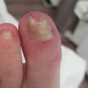 AVANT - ongle incarné Mme D