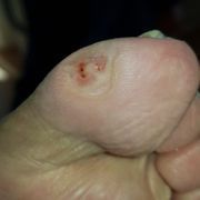 APRÈS - Cors au pied Mme C