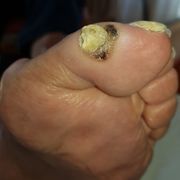 AVANT - Cors au pied Mme C