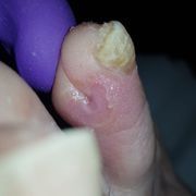 AVANT - ongle incarné Mme D