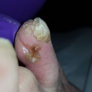 APRÈS - ongle incarné avec dégagement de la plaie Mme F