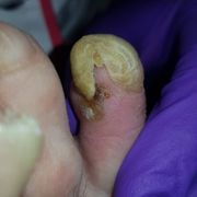 AVANT - ongle incarné Mme F