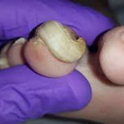 AVANT - ongle incarné Mme F