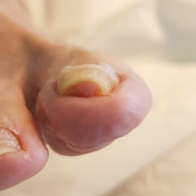 +6 MOIS - Ongles avec bride et blocage de courbure pied droit Mme A