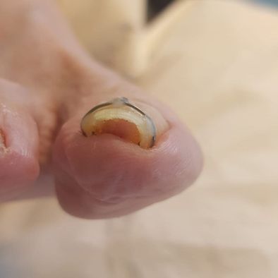 +8 mois - Ongle avec agrafe pied gauche Mme A