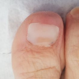 APRÈS Onychoplastie