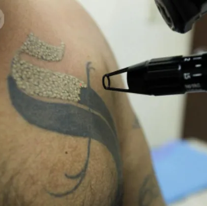 Un hombre se está quitando un tatuaje del brazo.