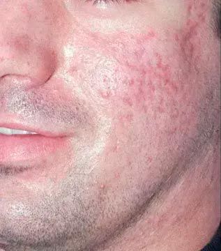 Primer plano del rostro de una persona con cicatrices de acné visibles y enrojecimiento en las mejillas y los laterales de la cara.