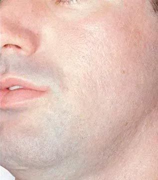 Primer plano del rostro de una persona; la piel es pálida con una ligera barba incipiente; los labios están ligeramente entreabiertos.