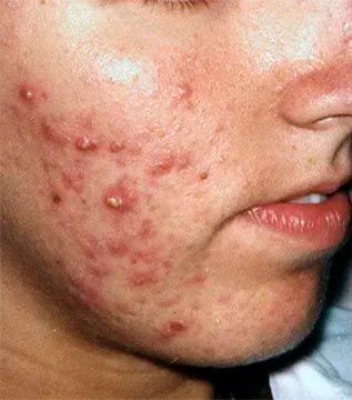 Primer plano del rostro de una persona con numerosos granos rojos e inflamados, lo que indica acné severo.