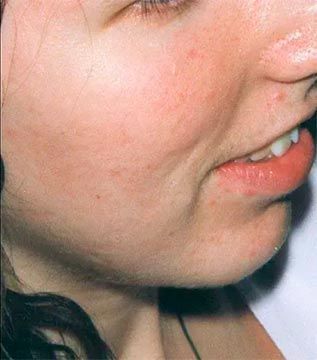 Primer plano del rostro de una persona que muestra la boca ligeramente abierta, los dientes visibles y la piel rojiza con pequeñas imperfecciones.