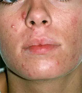 Primer plano del rostro de una persona que muestra la piel afectada por el acné con protuberancias rojas y blancas.