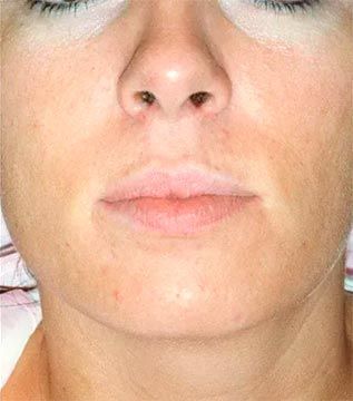 Primer plano del rostro de una persona; se ven la nariz, los labios y las mejillas con un tono de piel claro.